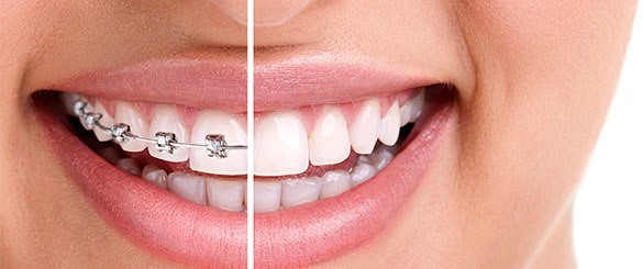 ortodonzia-roma-paolo-dangelo-dentista-denti-